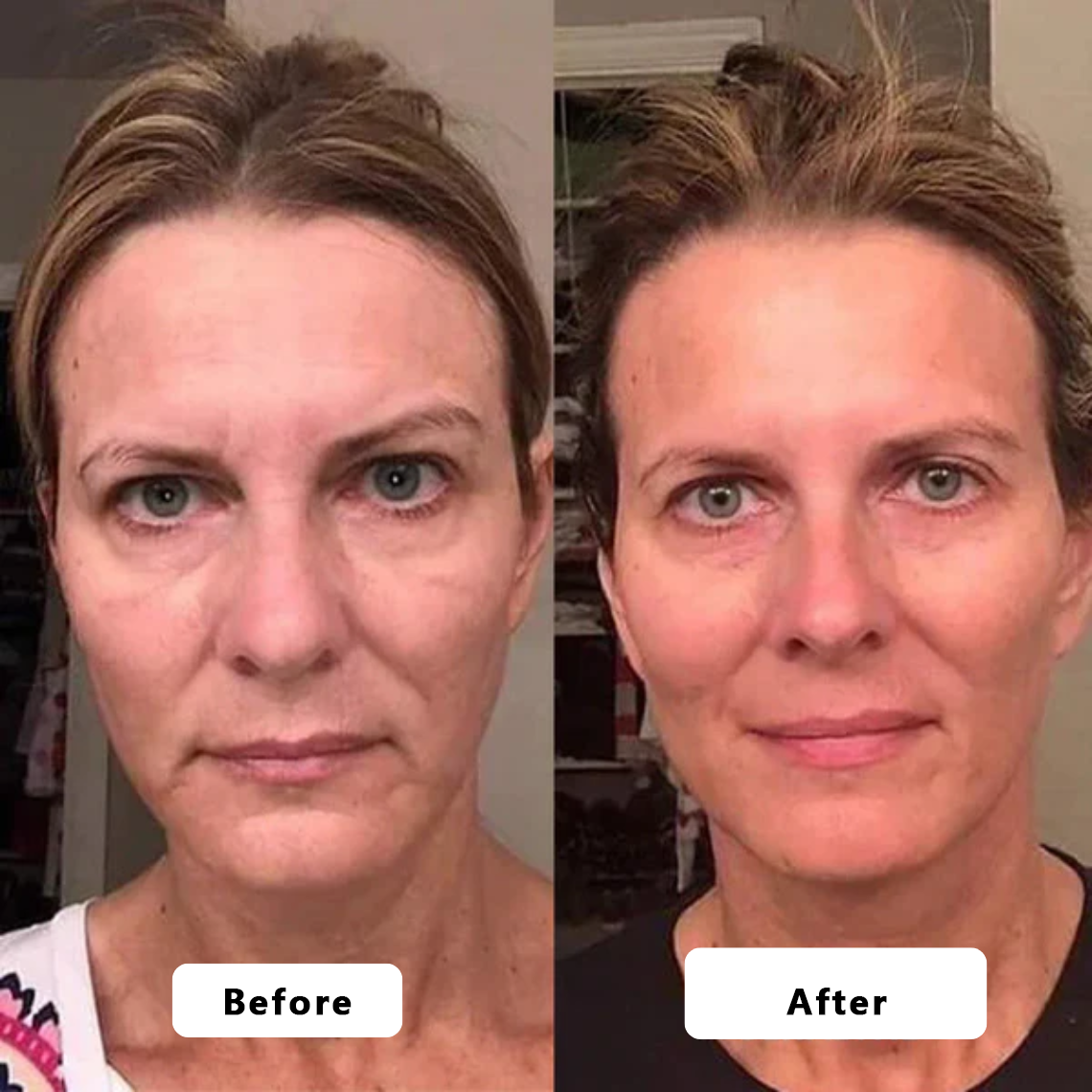 🍇Rejuvenate Your Skin with Micro Infusion Technology Tighter, Firmer & Younger-Looking Skin Starts Here