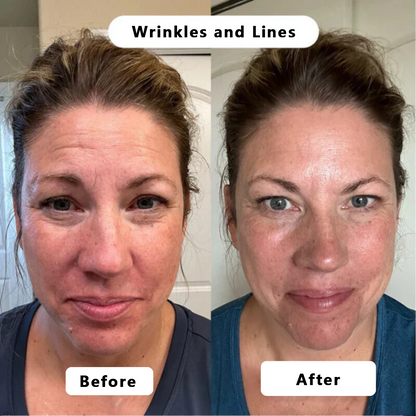 🍇Rejuvenate Your Skin with Micro Infusion Technology Tighter, Firmer & Younger-Looking Skin Starts Here